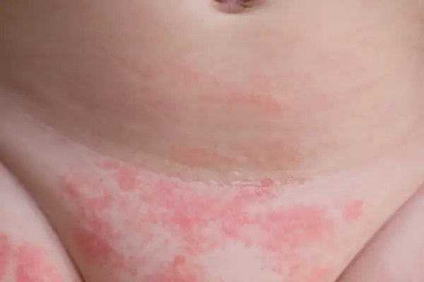 Objawy uczulenia na pampersy: Ratuj skórę dziecka przed bolesną wysypką