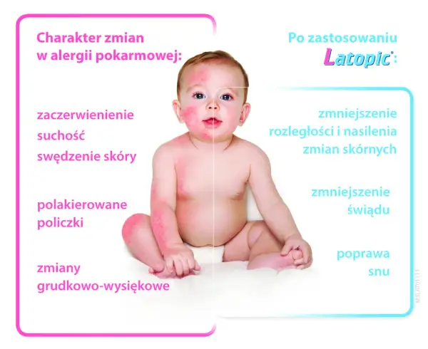 Objawy AZS u niemowlaka: Jak rozpoznać i złagodzić uciążliwe dolegliwości